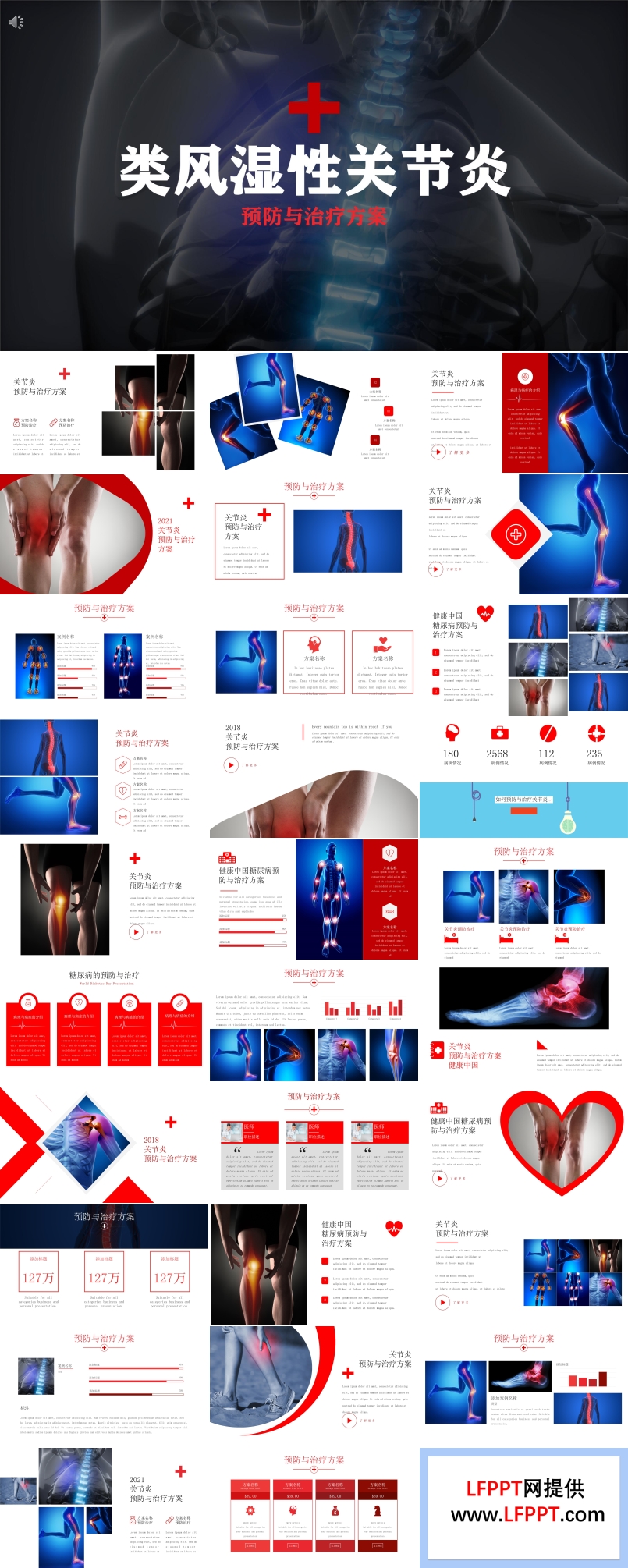 类风湿性关节炎ppt